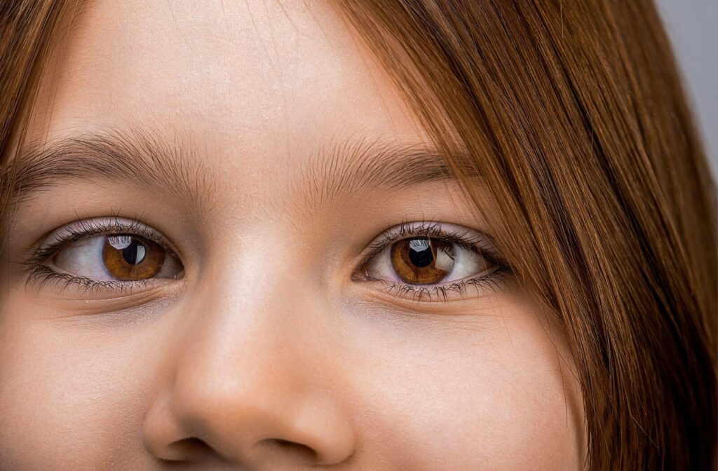 Strabismus in children causes, treatment concept. Female eyes with strabismus. Hypertropia. Strabismus. Closeup part child's face, eyes girl. Little patient strabismus, treatment ophthalmic diseases.